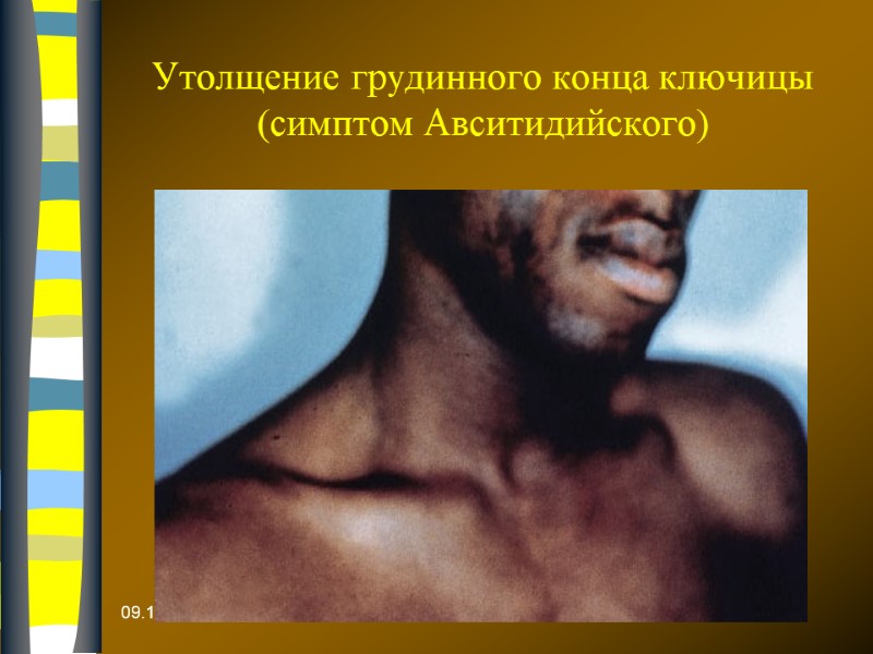 Утолщение грудинного конца ключицы  (симптом Авситидийского) 09.12.2017